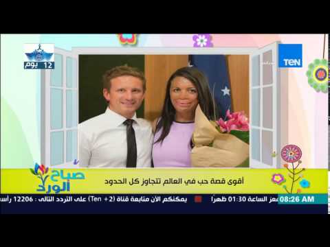 أسترالي يطلب الزواج من حبيبته بعد تشوه جسدها